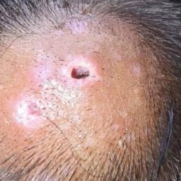ALERTA SANITARIA EN CENTROAMÉRICA Y MÉXICO POR AUMENTO DE CASOS DE GUSANO BARRENADOR EN HUMANOS