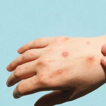 OMS MANTIENE ALERTA POR EPIDEMIA DE MPOX EN ÁFRICA Y SOLICITA APOYO INTERNACIONAL