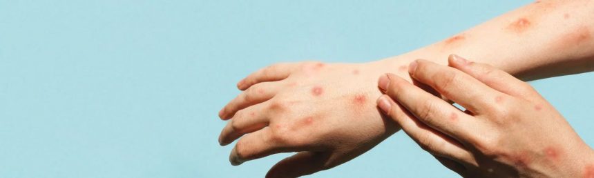 OMS MANTIENE ALERTA POR EPIDEMIA DE MPOX EN ÁFRICA Y SOLICITA APOYO INTERNACIONAL