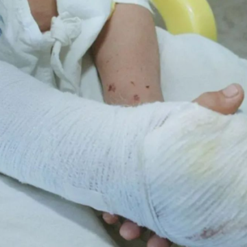 DISMINUYEN CASOS DE QUEMADURAS POR PÓLVORA DURANTE NAVIDAD EN EL SALVADOR, REPORTAN CUERPOS DE SOCORRO