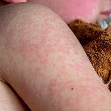 sarampion EL SALVADOR ACUMULA 58 CASOS DE SARAMPIÓN; SAN SALVADOR CONCENTRA MÁS DE LA MITAD DE LOS CONTAGIOS